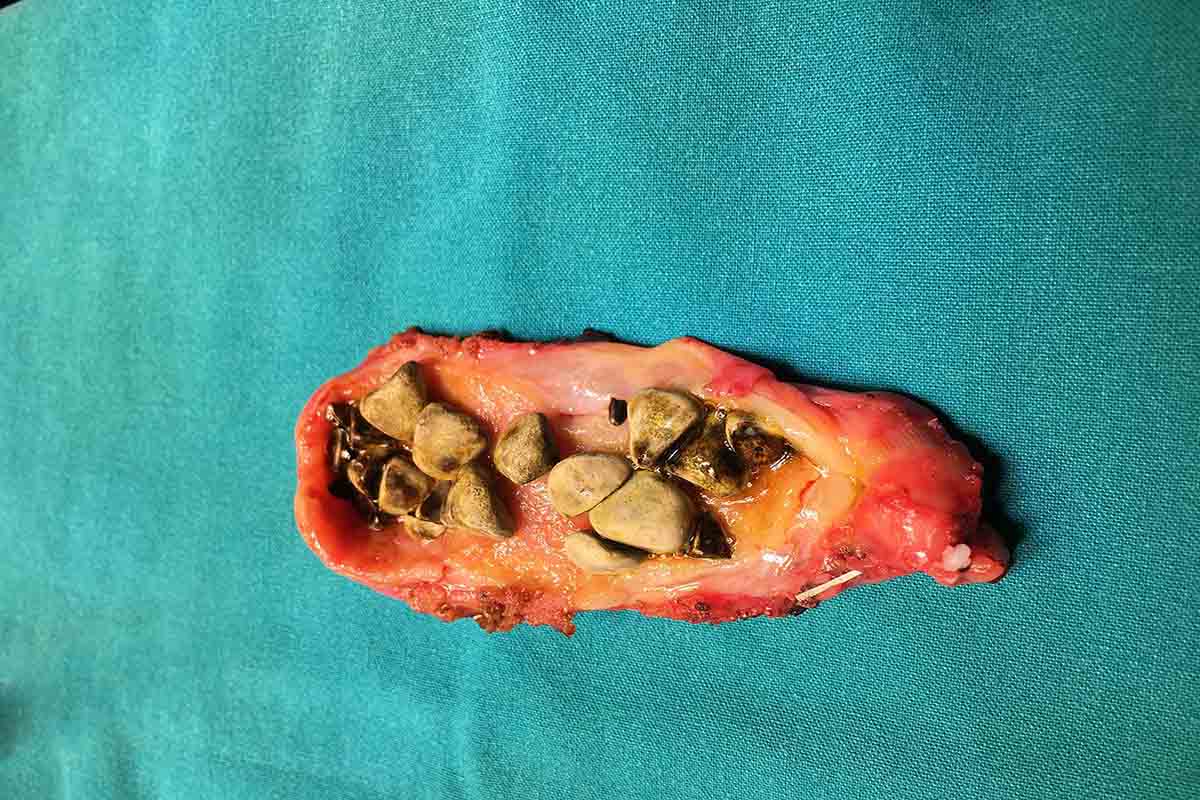 นิ่วในถุงน้ำดีที่เกิดจากคอเลสเตอรอล (Cholesterol stones)